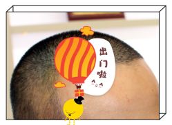 -大麦微针植发全国连锁