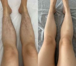 -薇兰专业脱毛连锁机构