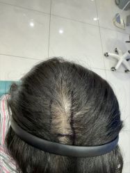 -碧莲盛不剃发植发
