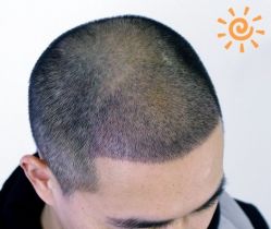 -大麦微针植发丨全国连锁