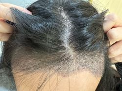 -碧莲盛·不剃发植发