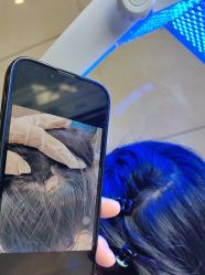 -碧莲盛·不剃发植发