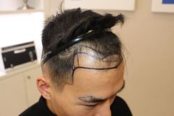 -大麦微针植发丨全国连锁