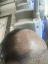 -碧莲盛·不剃发植发