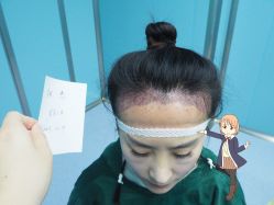 -大麦微针植发丨全国连锁