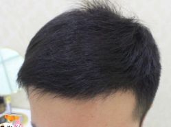 -大麦微针植发丨全国连锁