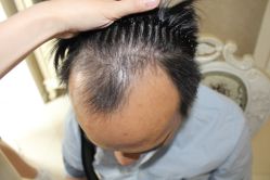 -大麦微针植发丨全国连锁