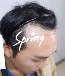 -大麦微针植发全国连锁