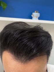 -大麦微针植发全国连锁