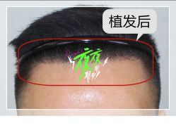 -大麦微针植发全国连锁