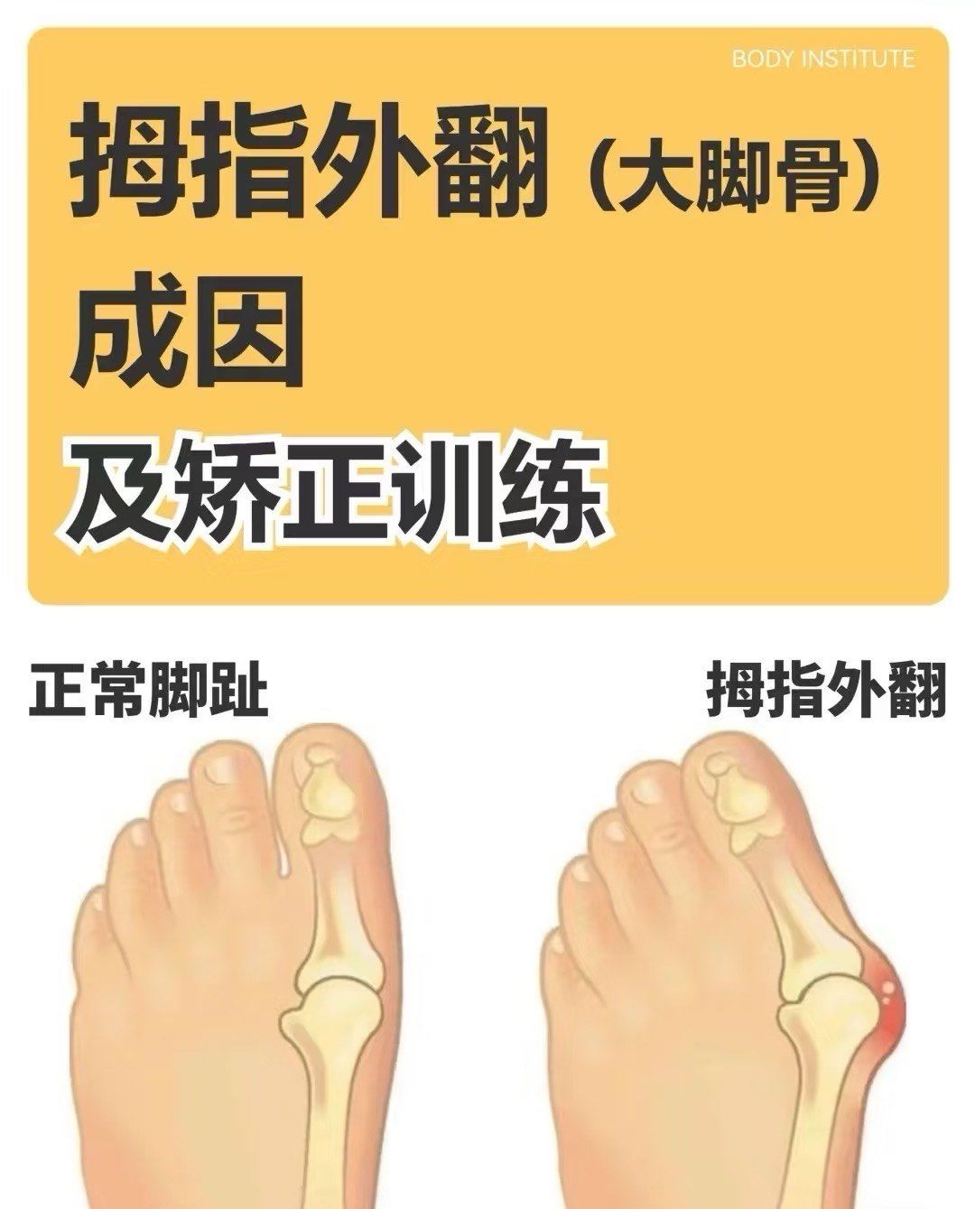 拇指外翻