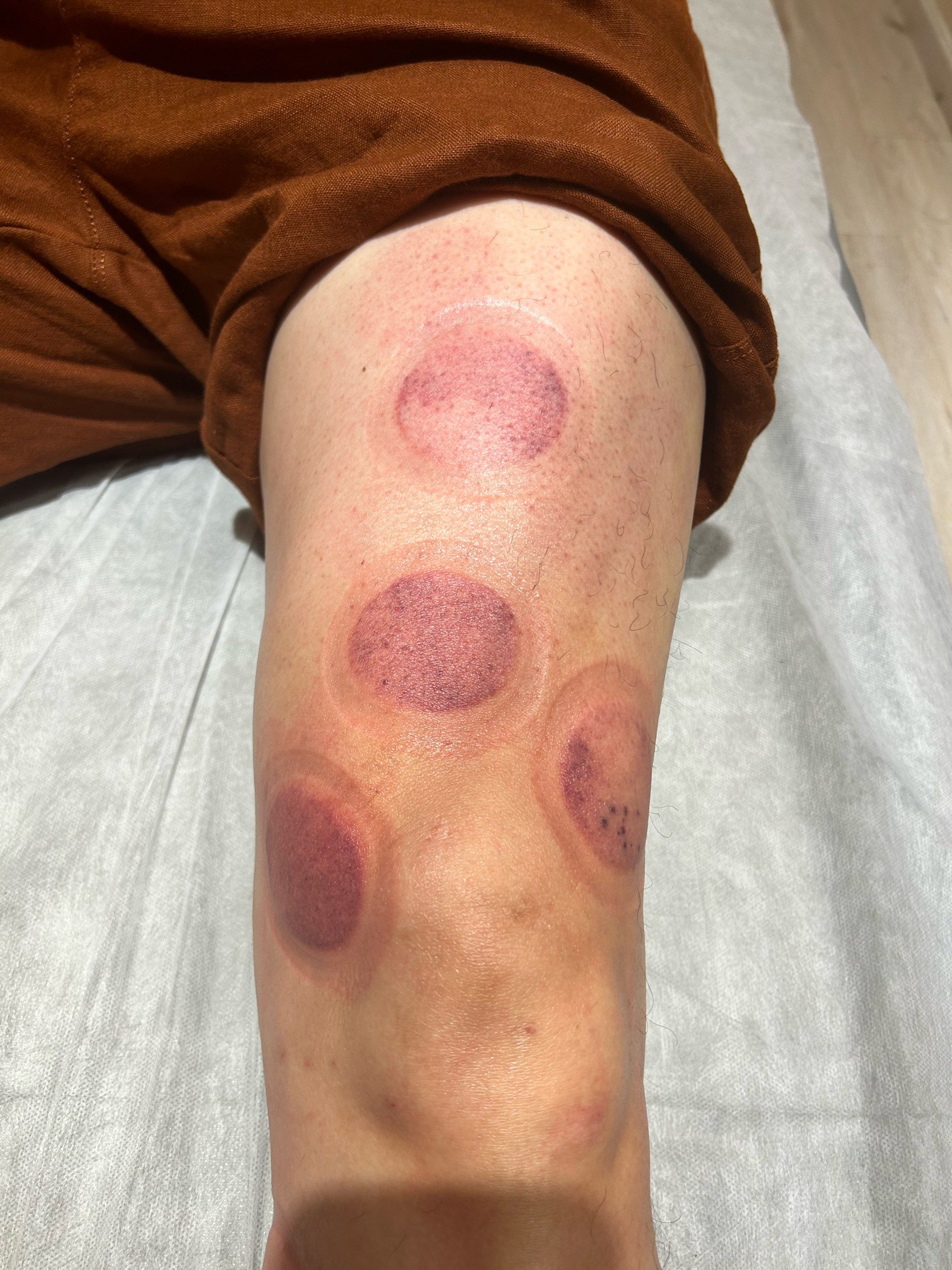 膝盖积液也可以做灸