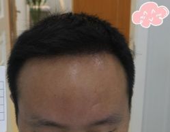 -大麦微针植发丨全国连锁