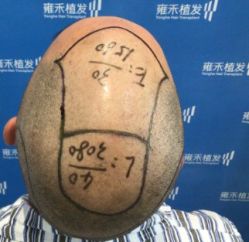 -雍禾植发全国连锁