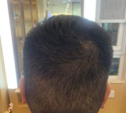 -大麦微针植发丨全国连锁
