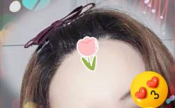 -大麦微针植发全国连锁