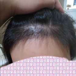 -大麦微针植发全国连锁