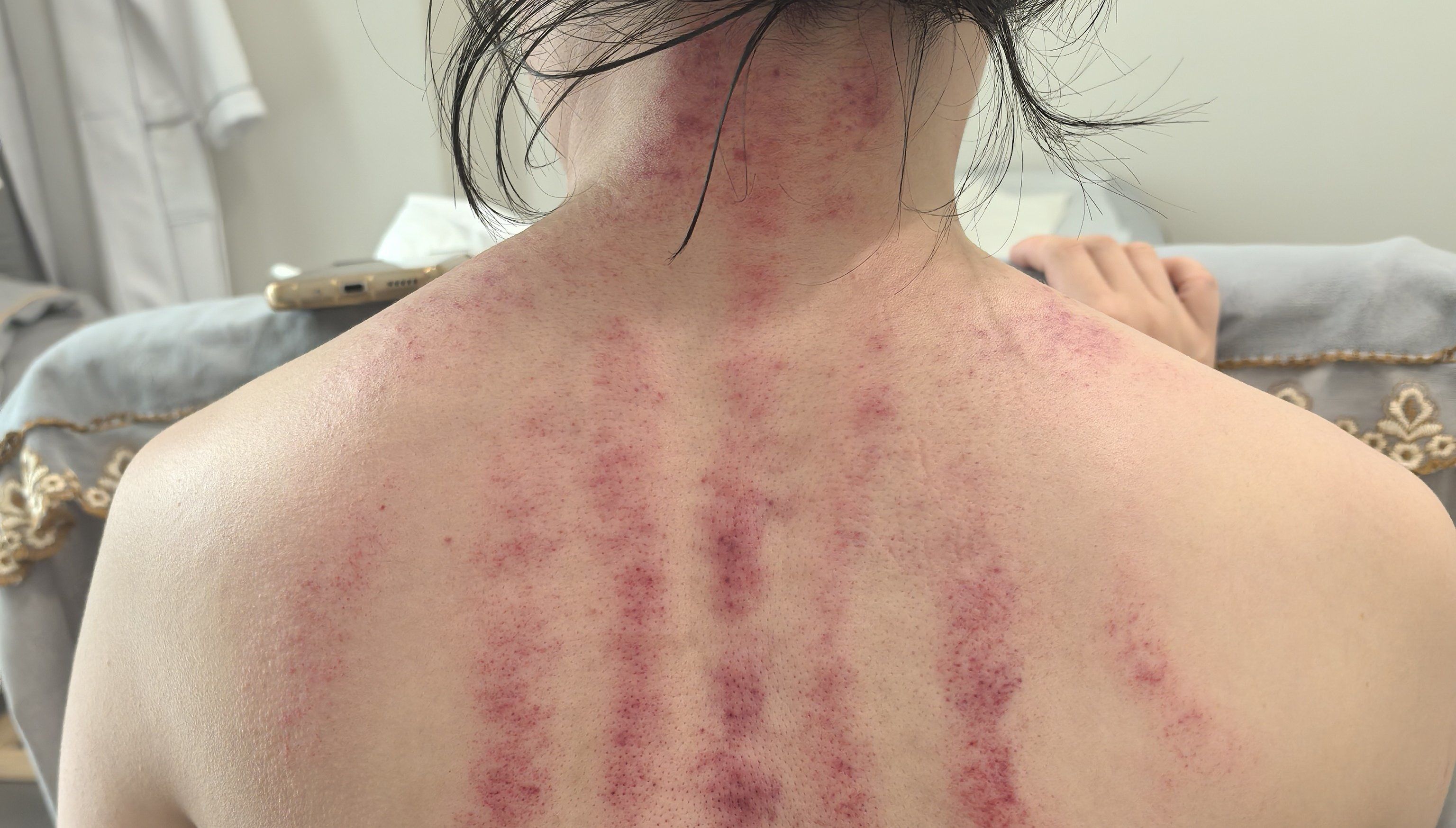 今天你刮痧了吗