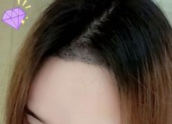 -大麦微针植发丨全国连锁