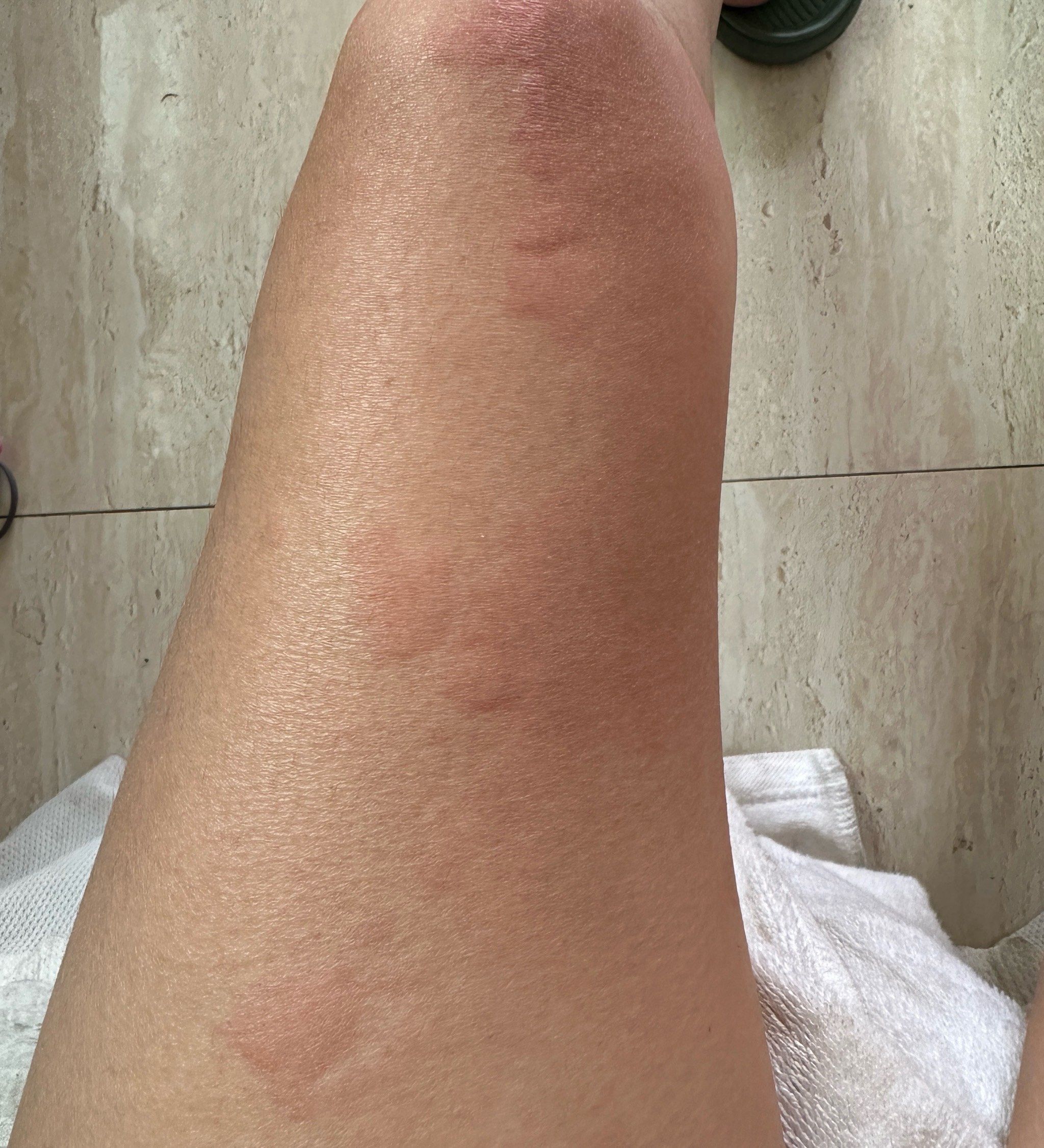 吃完番茄无刺骨鱼面🍝身体就起很多包,是过敏吗