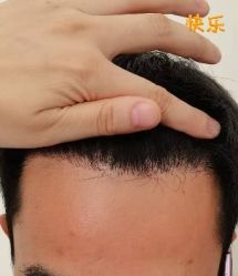 -大麦微针植发丨全国连锁