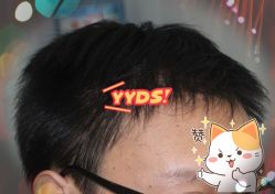 -大麦微针植发全国连锁