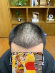 -大麦微针植发全国连锁