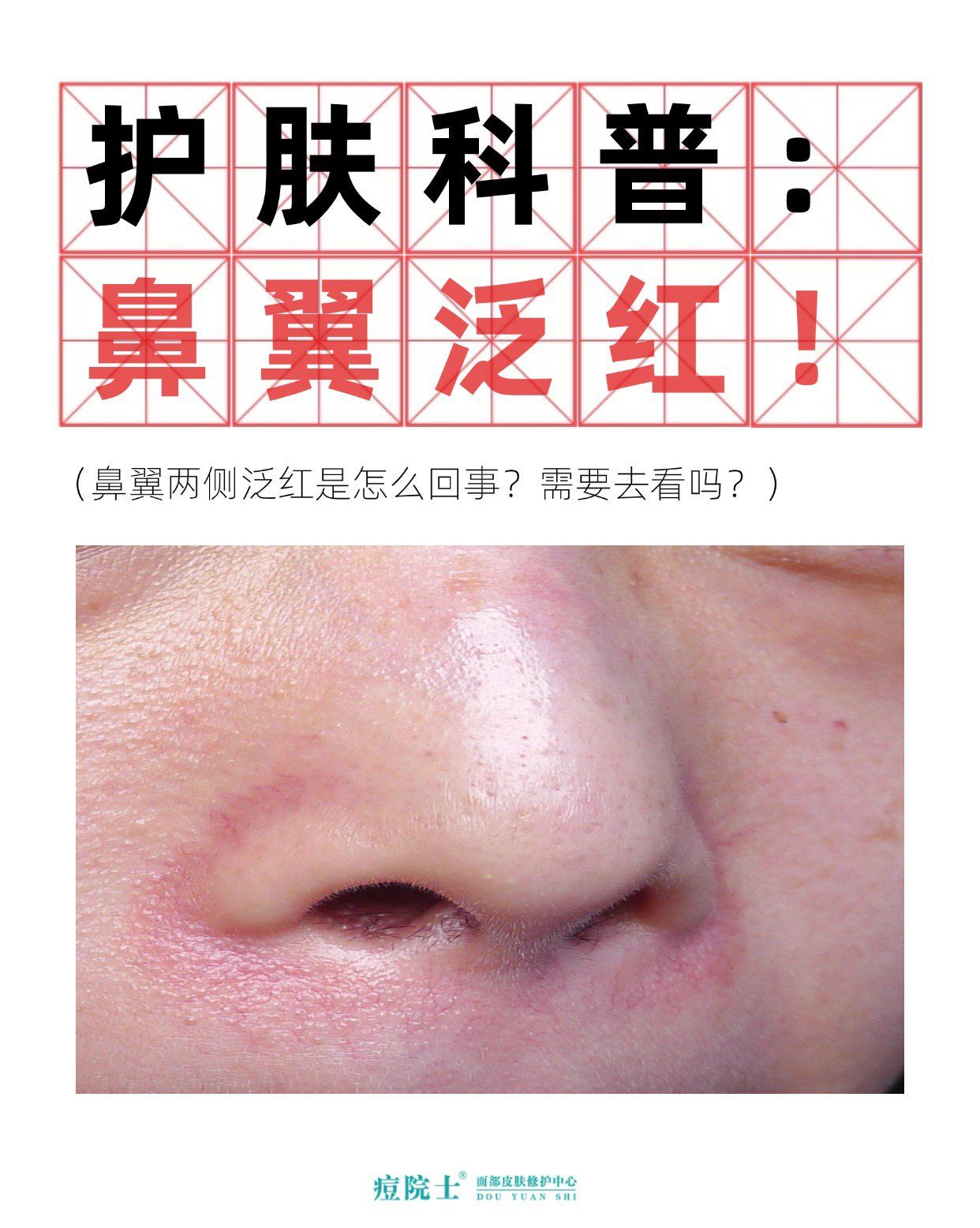 鼻翼两侧总是红红的?