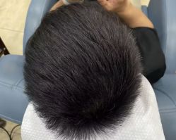 -大麦微针植发全国连锁