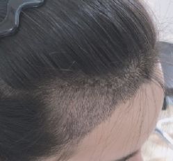 -大麦微针植发全国连锁