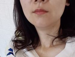 点击看大图 体验后-海涛医疗美容·面部抗衰·注射美鼻