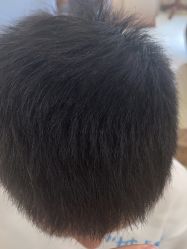 -碧莲盛·不剃发植发