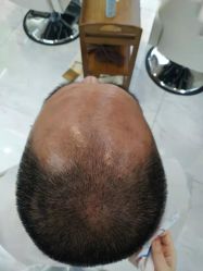 体验前-大麦微针植发丨全国连锁