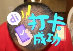 -大麦微针植发全国连锁
