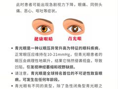 -黑马眼科·近视手术