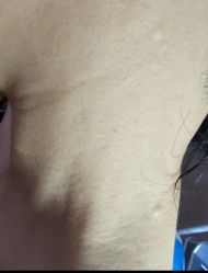 -爱莎扁平疣·汗管瘤·斑痣中心