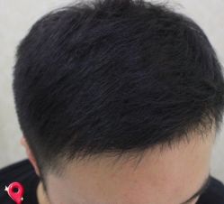 -大麦微针植发丨全国连锁