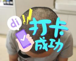 -大麦微针植发全国连锁