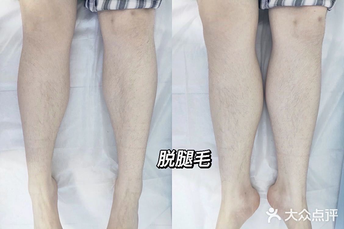 郑州超级专业的脱毛中心 冰优优
