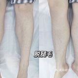 郑州超级专业的脱毛中心 冰优优