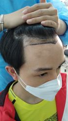 -大麦微针植发丨全国连锁