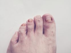 第五周-派恩宜灰指甲鸡眼嵌甲手足癣