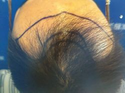 -雍禾植发全国连锁