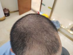 -碧莲盛·不剃发植发