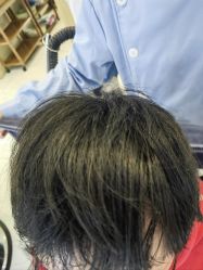 -大麦微针植发丨全国连锁