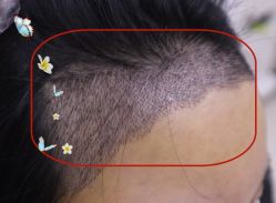 -大麦微针植发全国连锁