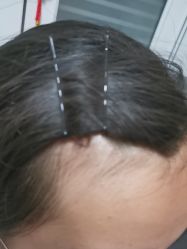 -北京美痣堂古方祛痣斑疣瘊