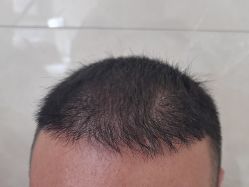 -碧莲盛·不剃发植发