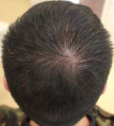 -大麦微针植发丨全国连锁