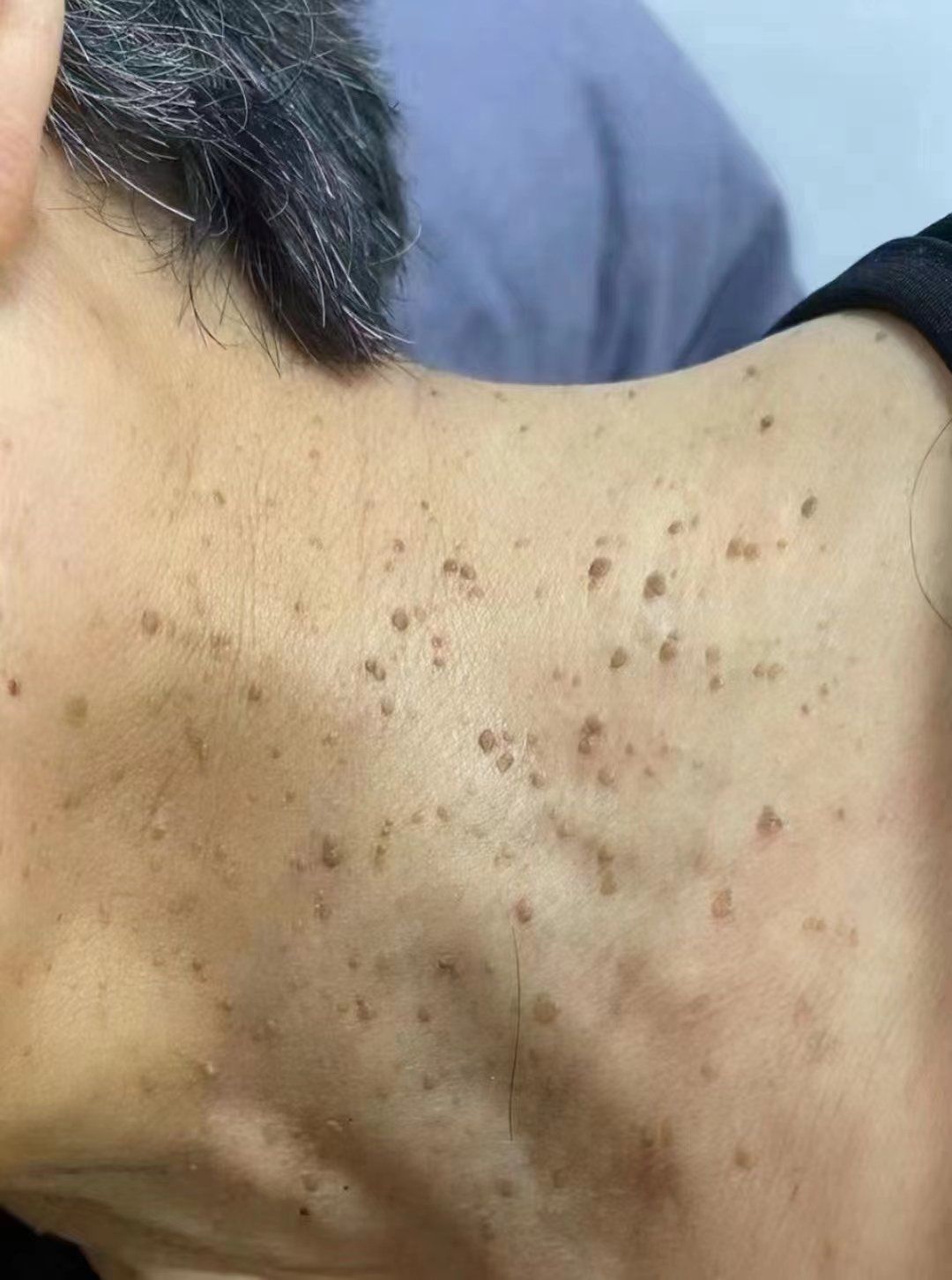 扁平疣,传染家人孩子